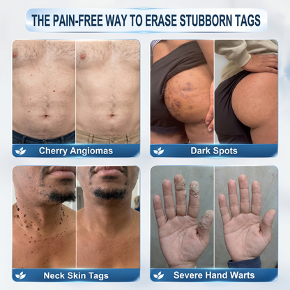 Authorized Flagship Store ✨|🌥️𝐕𝐢𝐭𝐚𝐥𝐢𝐬𝐲𝐬® 7-𝐷𝑎𝑦 𝗧𝐚𝐠 & 𝗦𝗽𝐨𝐭 𝐄𝐫𝒂𝒔𝒆𝒓(Zero Pain, Zero 𝐒𝐜𝐚𝒓𝒔 Rollerball)❤️